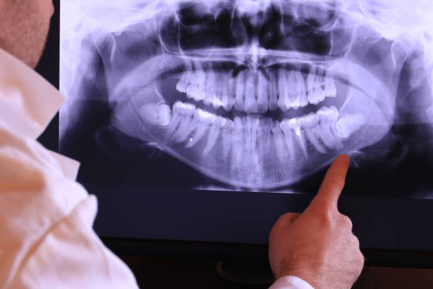 Best Emergency Wisdom Teeth Removal in Belle Chasse, LA