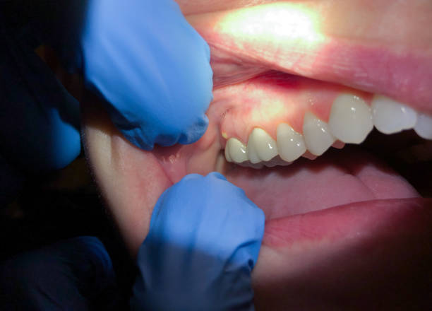 Best Emergency Root Canal Treatment in Belle Chasse, LA